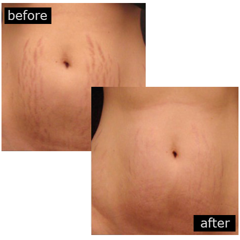 Stretch Marks Removal Treatments in Birmingham by Designing Faces