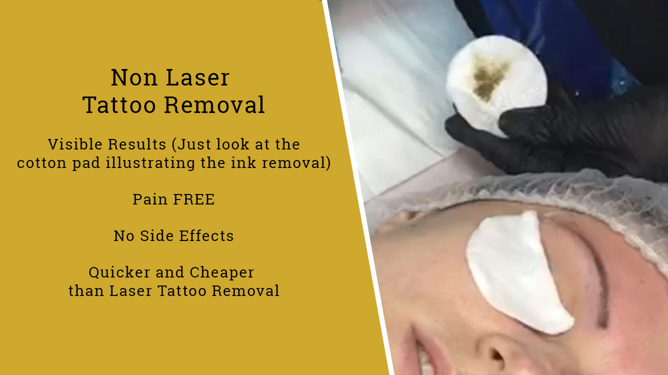 Tattoos & eyebrows Laser removal Birmingham